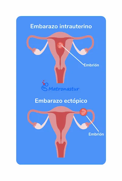 Embarazo ectópico matronastur